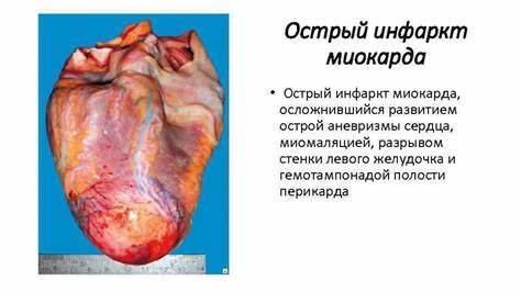 Ишемическая болезнь Макропрепараты Инфаркт миокарда 1 Картинка - Ишемическая болезнь Макропрепараты Инфаркт миокарда 1
