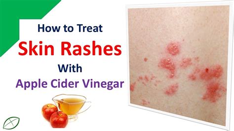 How To Treat Skin Rashes With Apple Cider Vinegar Youtube