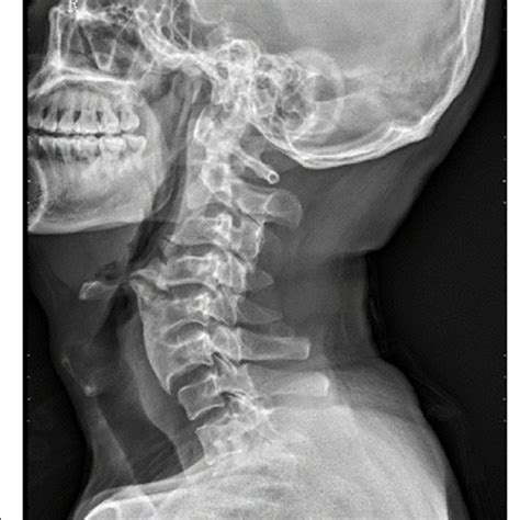 A Lateral Cervical Spine Mri Displayed Osteophyte From C3 To C6