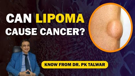 Can Lipoma Cause Cancer Lipoma Causes Symptoms Types Treatment In