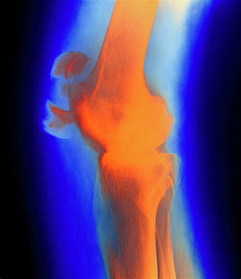 Coloured X Ray Image Of A Fractured Kneecap Photograph By Dept Of