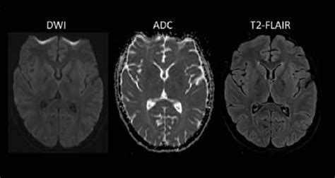 Diffusion Weighted Images Dwi Adc Maps And Axial T2 Flair Weighted