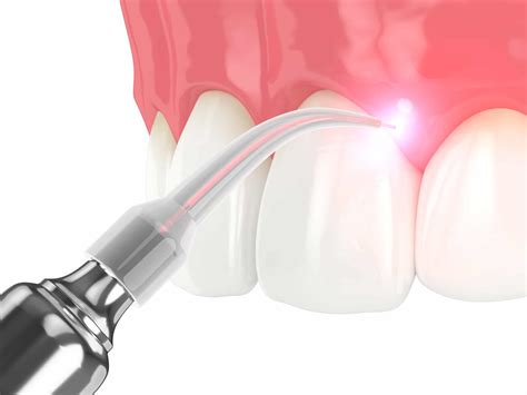 Laser Dentistry In Houston Tx Laser Teeth Whitening