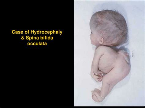 Ppt Congenital Malformation Of Brain Powerpoint Presentation Free