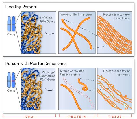 Marfan Syndrome Discovery