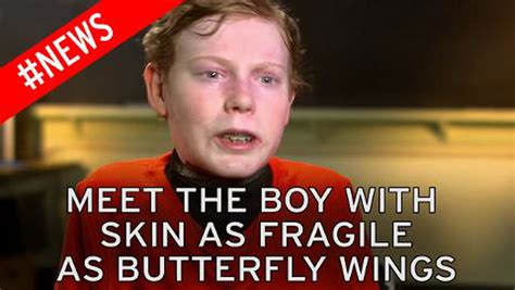Agony Of Butterfly Boy Meet Inspirational Eb Sufferer Who Raised £65k