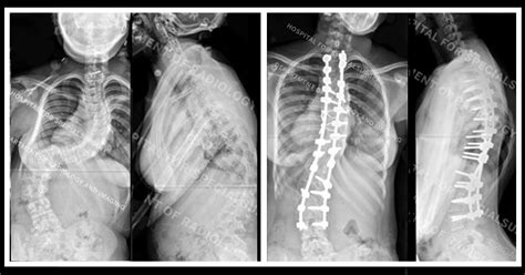 Neuromuscular Scoliosis From Neurological Or Muscular Issues