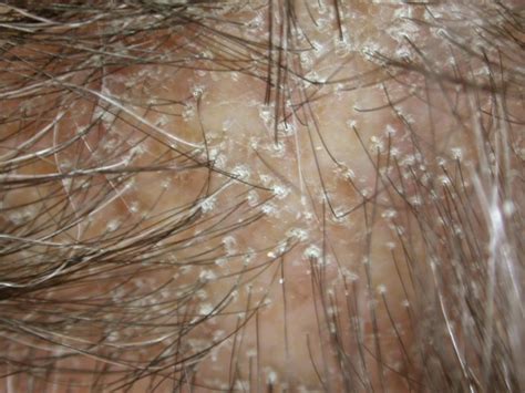 Lichen Planopilaris Pictures Causes Treatment Diagnosis