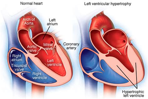 Left Ventricular Hypertrophy Causes Symptoms Diagnosis And Treatment