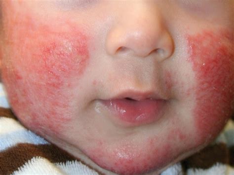 Allergic Contact Dermatitis Types Causes And Treatments