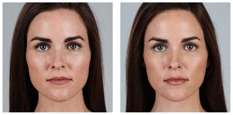 Dermal Fillers For Facial Volume Merrimack Valley Laser Aesthetic