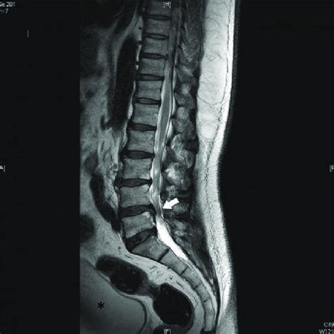 Pre Operative Lumbar MRI Showing A Right Paracentral Disc Herniation At Download Scientific
