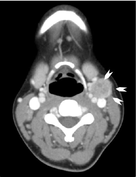 Neck Ct Scan Of The Patient Shows Enhanced Welldefined Mass In The Soft