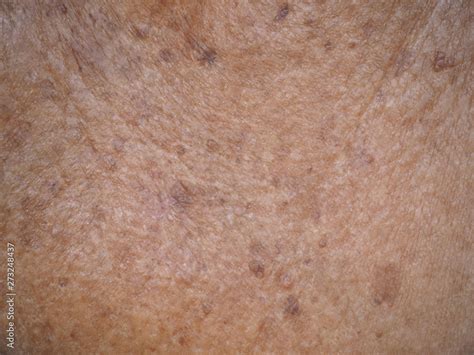 Actinic Keratosis Or Melanoma And Seborrheic Keratosis On Collarbone Be