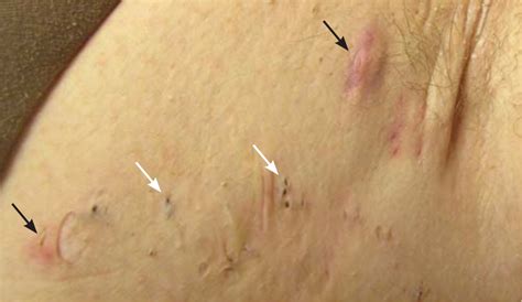 Hidradenitis Suppurativa Rapid Evidence Review Aafp