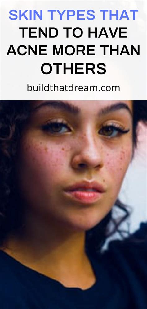 Skin Types That Tend To Have Acne More Than Others Build That Dream