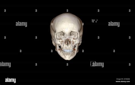 Computed Tomography Of The Skull Facial Bones In 3d Ct Vr Facial