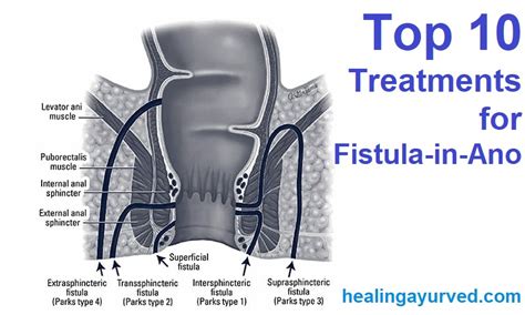 Top 10 Treatments For Fistula In Ano Healing Ayurved
