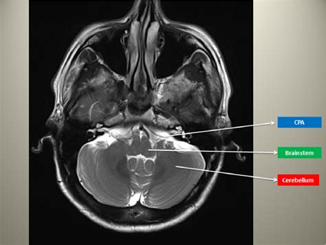 Posterior Fossa Tumors Clues To Differential Diagnosis With Case Based