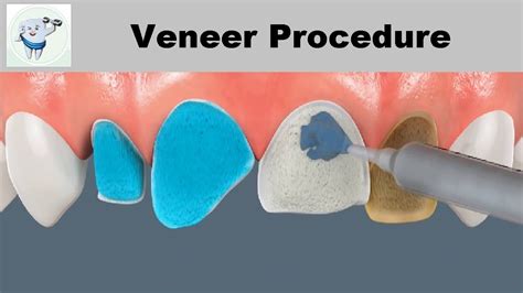 Dental Veneers Procedure Youtube