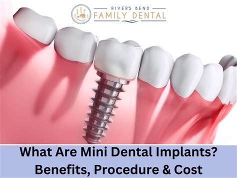 What Are Mini Dental Implants Difference Benefits And Cost