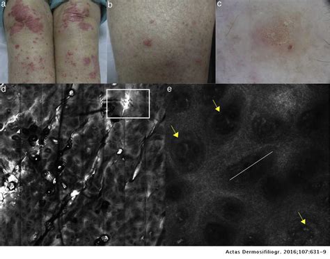 Reflectance Confocal Microscopy For Inflammatory Skin Diseases Actas