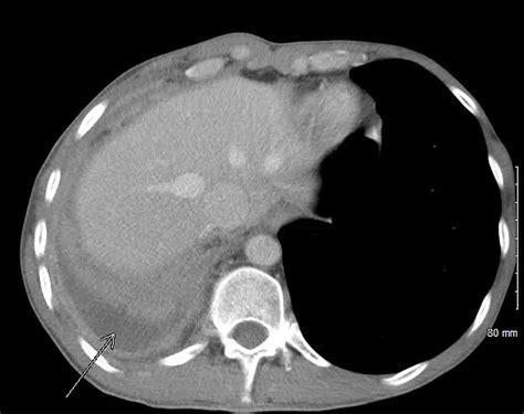 Transudative pleural effusion, where the excess pleural fluid is low in protein is caused by fluid leaking into the pleural space. Cureus | A Rare Case of Missing Primary in Metastatic ...