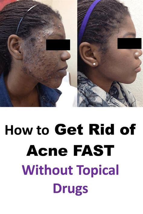 How To Get Rid Of Acne Fast → Naturally At Home Without Products How