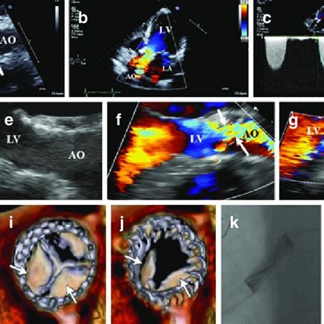 5 Imaging Features Of Prosthetic Valve Structural Deterioration