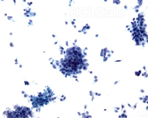 Adenocarcinoma Pancreas Cytology