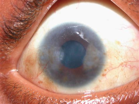 Community Eye Health Journal Vernal Keratoconjunctivitis