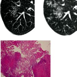 Acute Pulmonary Tuberculosis With Predominant Radiologic Findings Of