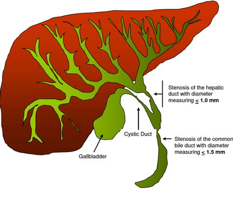 Graphical Representation Of The Intrahepatic And Extrahepatic Biliary