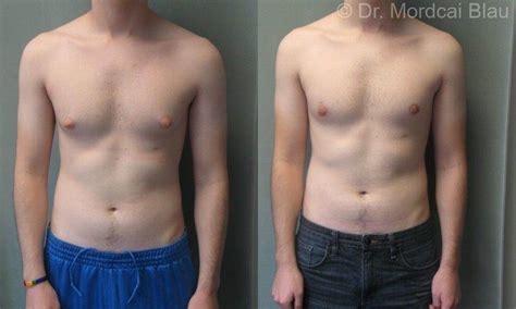 Puffy Nipples Before And After Photos Gynecomastia Usa