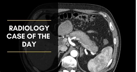 Radiology Case Of The Day Colllection Cases Radiogyan Radiogyan