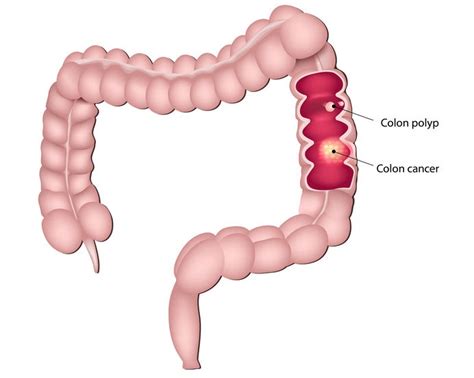 Using a colon between a verb and its object or complement. The Difference Between Colon Cancer and Hemorrhoids