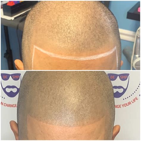 Gallery Philadelphia Scalp Micropigmentation