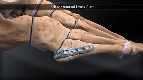 5th Metatarsal Hook Plate Youtube