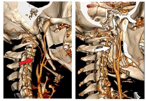 Internal Carotid Artery Dissection Due To Elongated Styloid Process