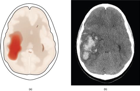 Traumatic Brain Injury Tbi Epidural Hematoma Extradural Haematoma