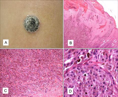 Figure 1 From A Pediatric Case Of Spitzoid Melanoma With Subsequent