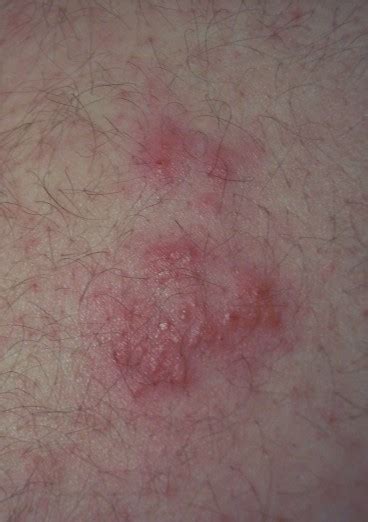 Need Help Anybody Know What This Is Back Rash Pic Dvd Talk Forum
