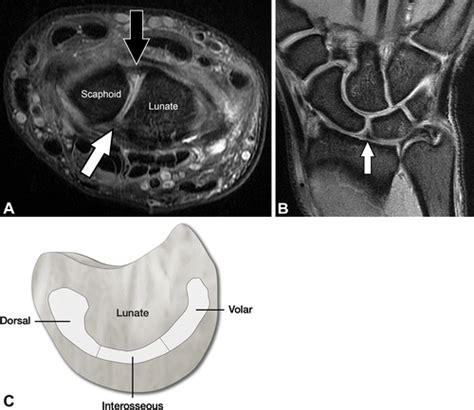 Preoperative And Postoperative Imaging Of Scapholunate Ligament Primary
