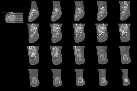 What Is A Foot Ct Or Cat Scan Two Views