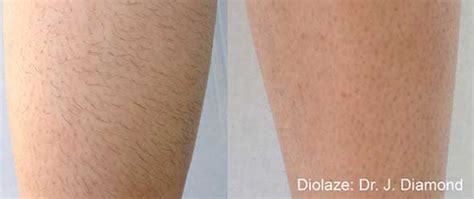 Mieten Regional Verwandelt Sich In Skin Discoloration After Laser