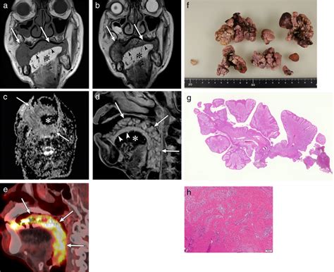 Mri Pet Ct And Pathological Examination Of The Lesion In Case 1 Mri