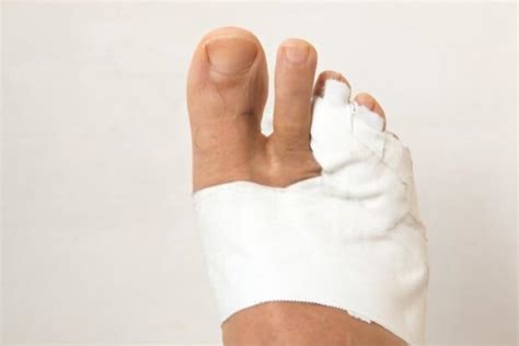 Dislocated Pinky Toe Causes Symptoms And 3 First Aid Treatments Healthweakness