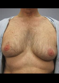 Gynecomastia Archives Dr Momtazi Plastic Surgeon M D M S C F R