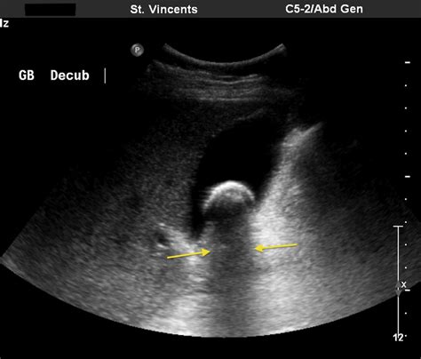 Top 101 Images Gall Bladder Stone Pictures Ultrasound Completed
