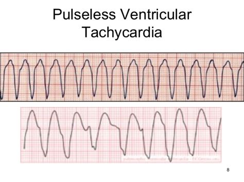 What Is Pulseless Ventricular Tachycardia